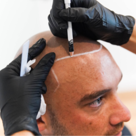 RPL - SHBBCOS007 - Provide Cosmetic Tattoo for Scalp Micropigmentation